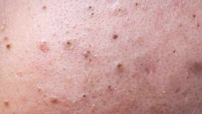 5 different types of acne on the skin, what causes them and simple home remedies to fix them