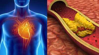 A study reveals that 1 in 13 adults under 30 already have hidden artery plaque