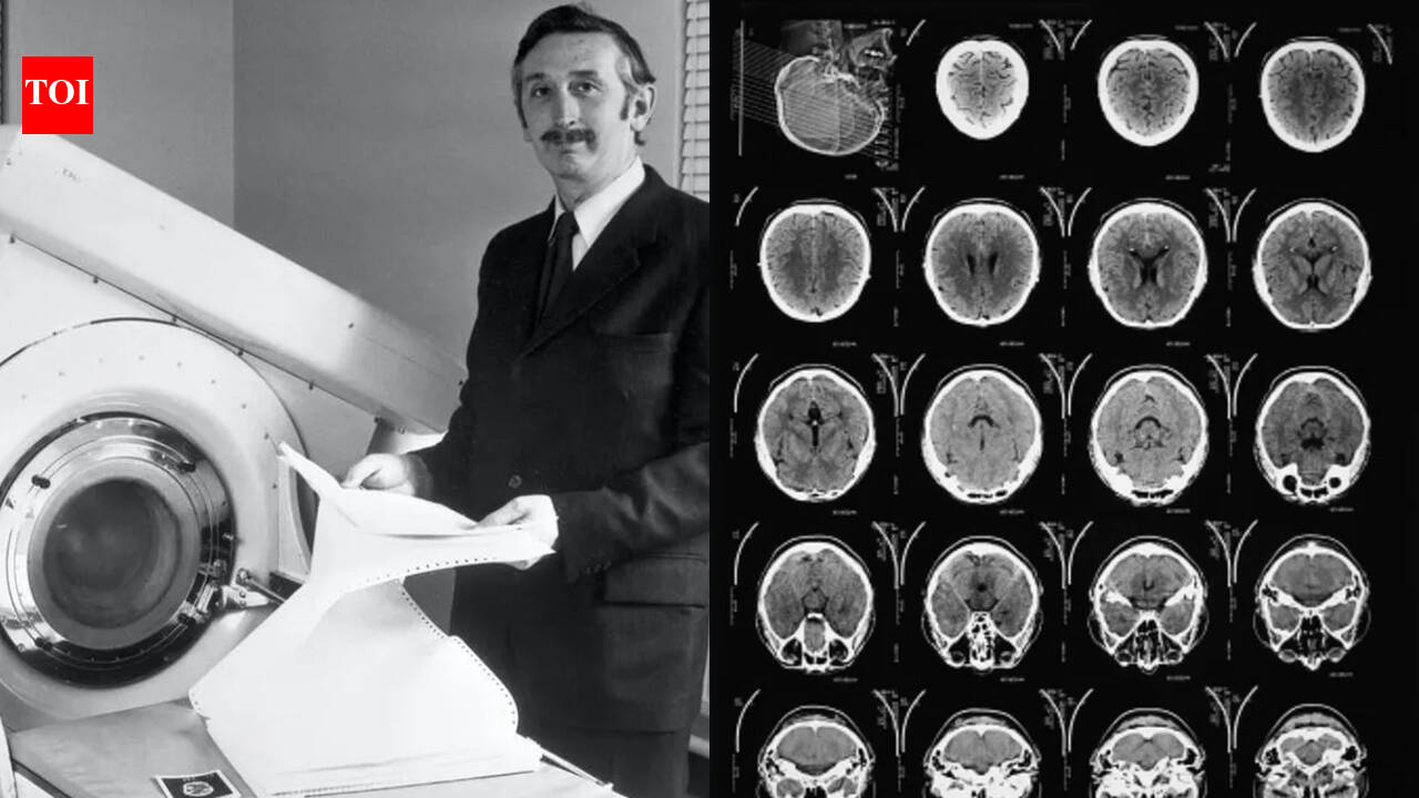 Godfrey Hounsfield’s CT scanner revealed a brain cyst in the first scan in 1971