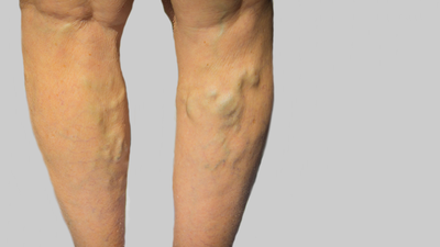 Have varicose veins? Vascular surgeon shares 3 simple tips to follow before playing Garba this Navratri