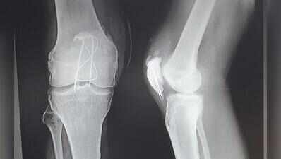 Knee pain cases among under-40s double post-Covid