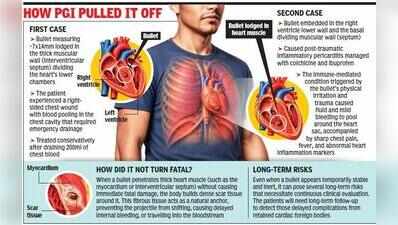 Bullets lodged in beating hearts: Clinical paradox managed without risky surgery