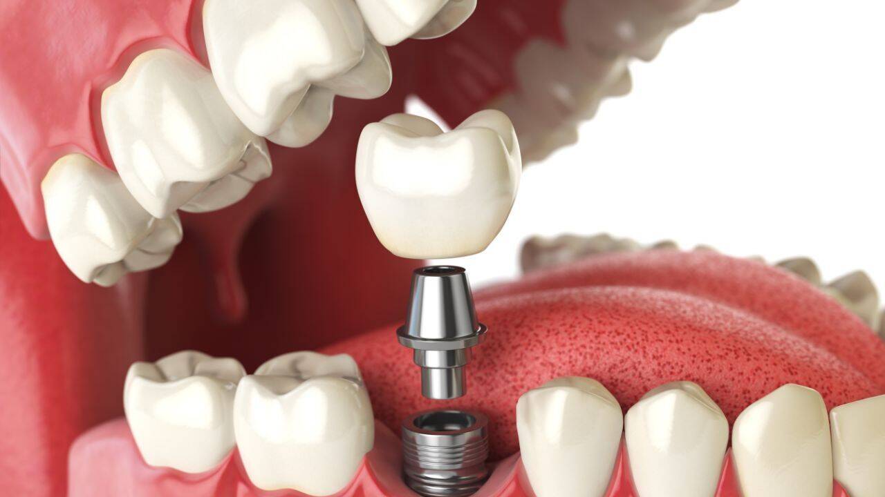 Can Dental implants hijack your immune system? · ContentVerse India