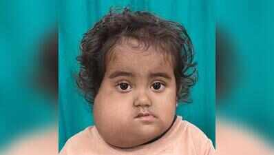 Docs remove jaw tumour from 3-yr-old