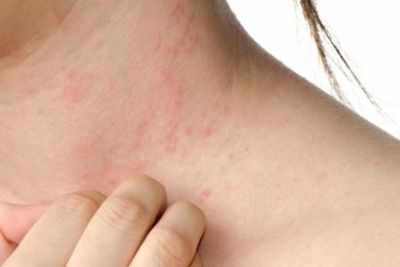 Top 10 health issues associated with lupus