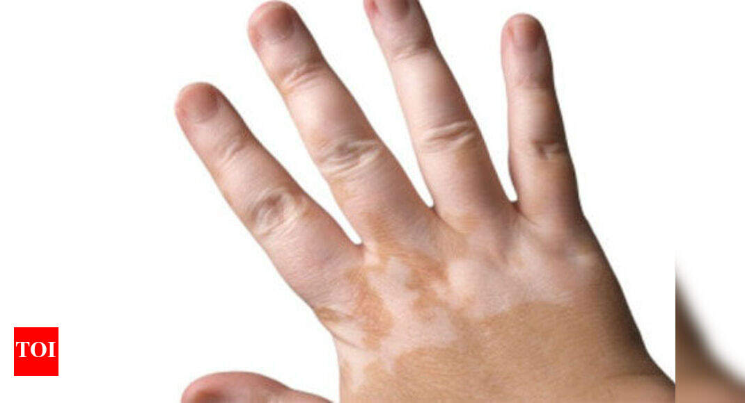 Here are the causes, main symptoms and treatment suggestion for Vitiligo. 