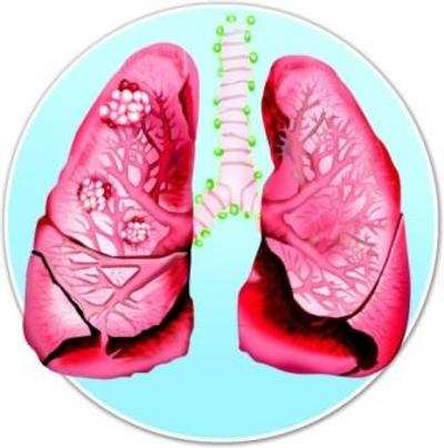 New drug could potentially treat lung cancer