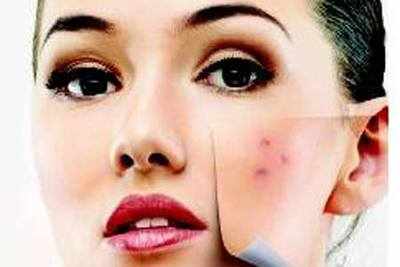 Do acne scars bother you?
