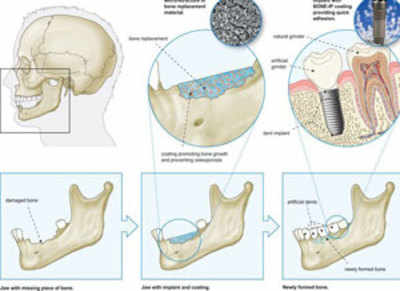 Teeth protein may help regenerate bone