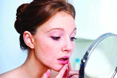 Try these quick remedies for acne