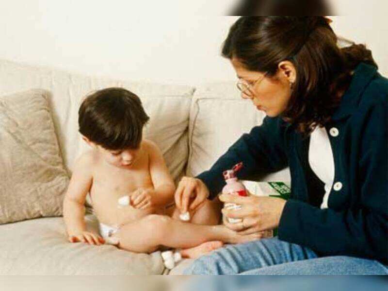 calamine lotion for baby acne