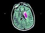 Cerebrovascular Disease affects the blood vessels in the brain