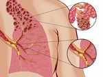 COPD is predicted to be one of the deadliest diseases