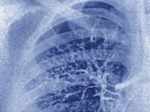 Lower Respiratory Infections are of two types: pneumonia, bronchitis and lung abscess