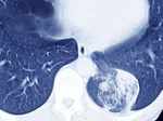 Lung cancer is caused by tumour developed in the tissues