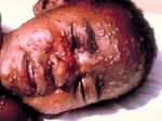 Approximately, 500 million people died due to smallpox in twentieth Century