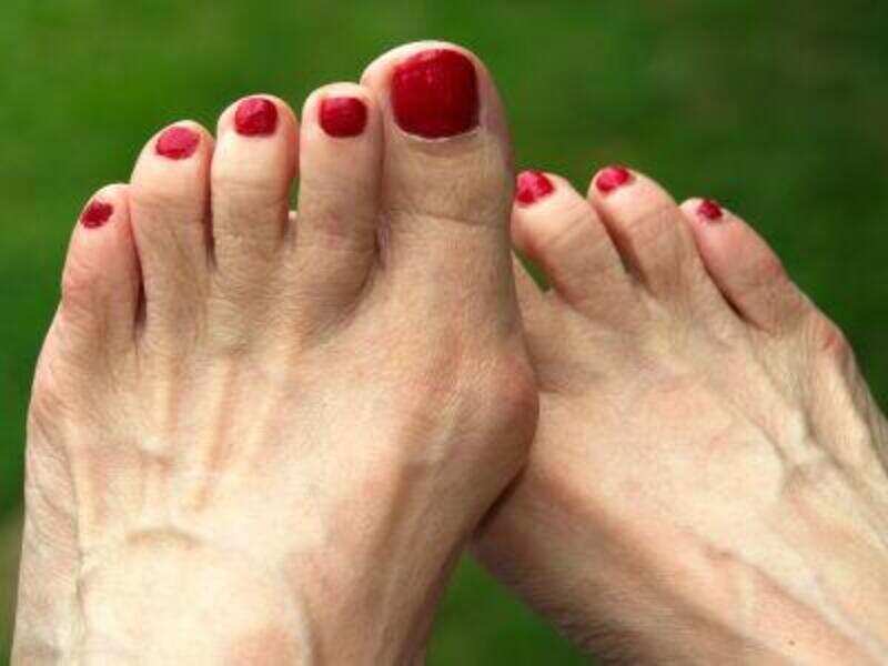 bunions on heels of feet