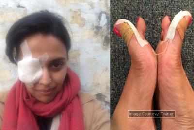 Actress Swara Bhaskar suffers severe eye injury