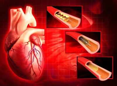 Government panel wants prices of stents, medical implants capped