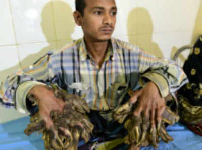 Surgery for Bangladesh's 'Tree Man' to remove warts