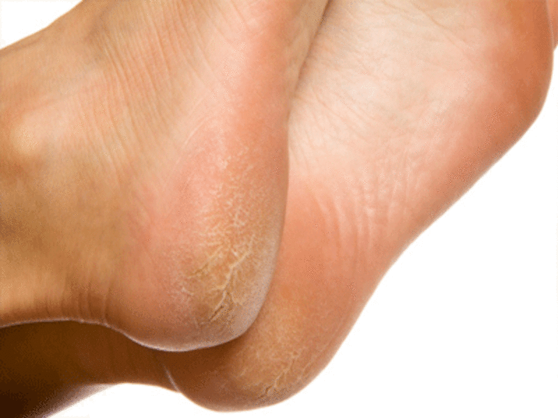 tips for foot crack