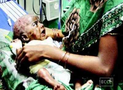 Tamil Nadu child treated for spontaneous combustion dies