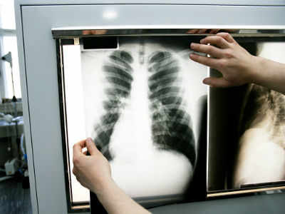 UP beats national avg in drug-resistant TB cases