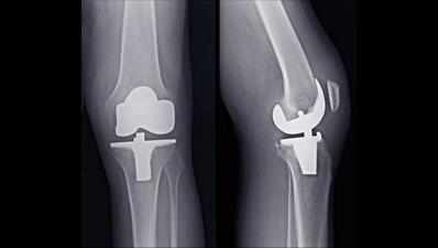Special knee designed to fit a women’s anatomy