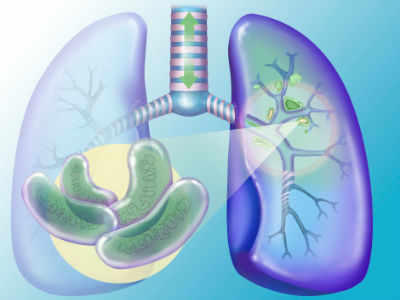 Delay in diagnosis leads to worsening of multidrug-resistant TB in country