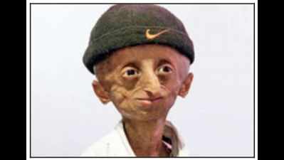 Progeria kid dies at 15 in Telangana