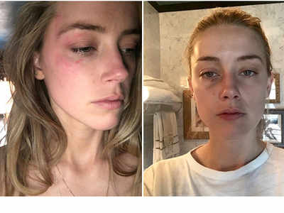 Amber Heard releases new photos of alleged domestic abuse by Johnny Depp