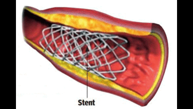 Stents make up only 25% of angioplasty cost: Study