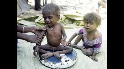 Dakshina Kannada sees dip in malnutrition cases