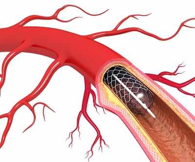 Stents in essential list, prices to be cut