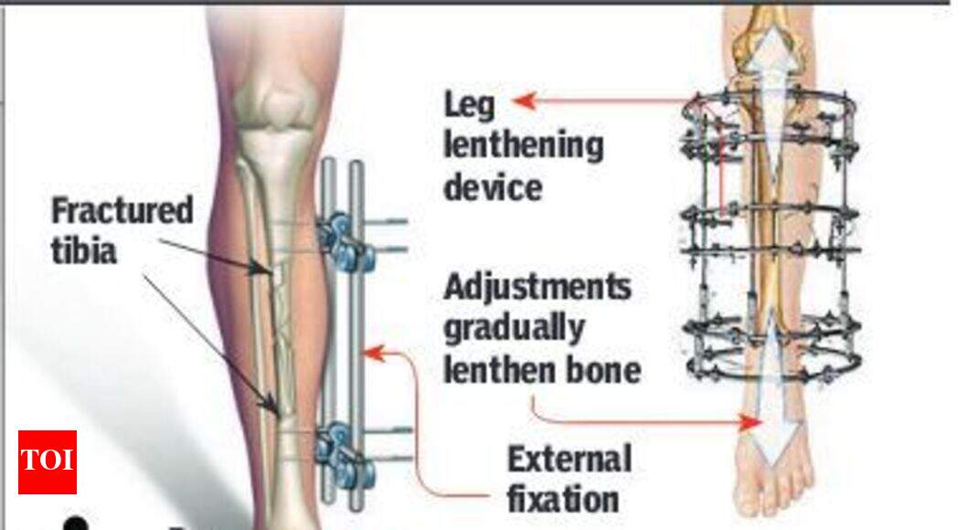 Leg Lengthening Device