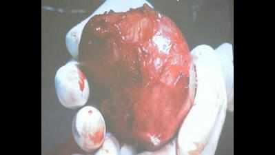 2.5kg tumour removed from 4-yr-old