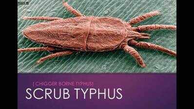 Scrub Typhus, the insect-borne disease | Kolkata News - Times of India