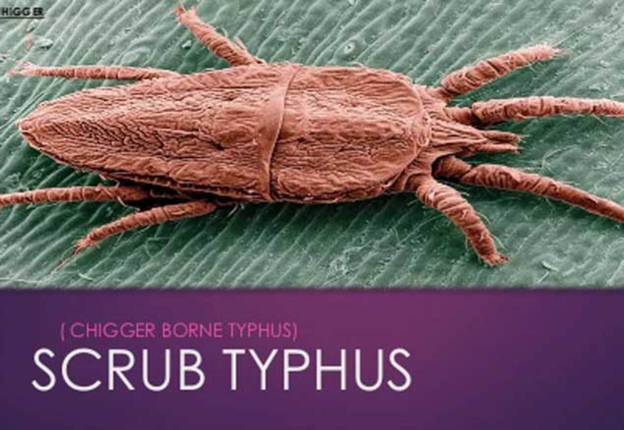 Scrub Typhus, the insect-borne disease | Kolkata News - Times of India