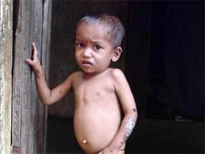 Malnutrition deaths over 5 months, says health minister