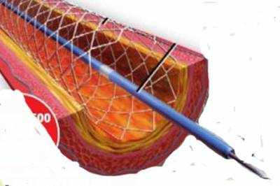 Stent implant count may soar after price capping