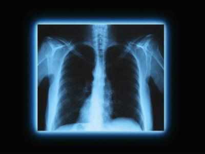 1m Indian TB patients fall off radar every year