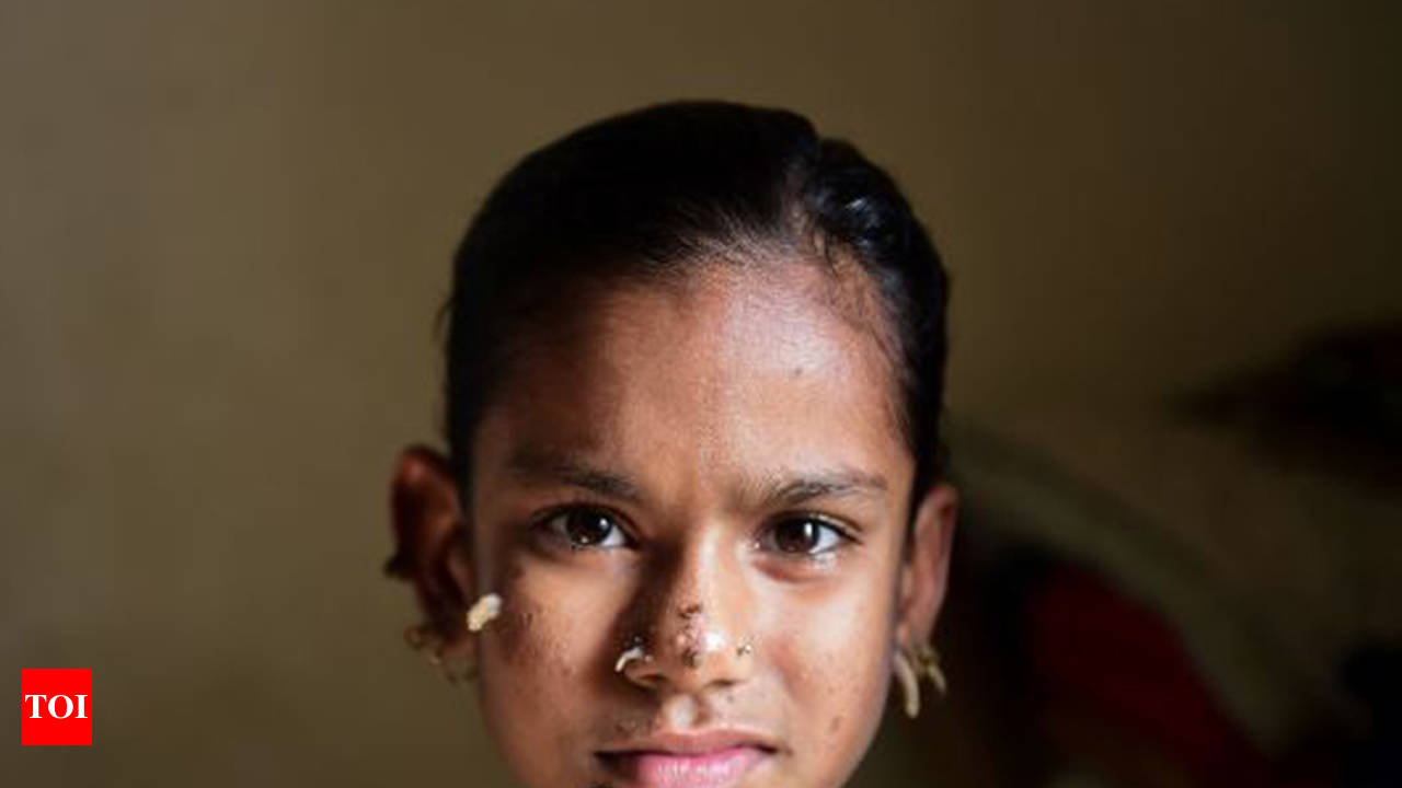 10-Year-Old Girl from Bangladesh May Be the First Female to Have 'Tree Man  Syndrome