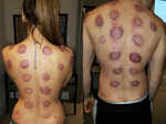 Sofia Hayat: Cupping Therapy