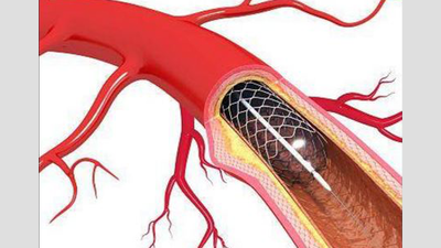 Eight hospitals under lens over ‘pricey’ stents