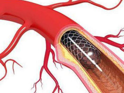 Stents sold in Europe much cheaper than in India