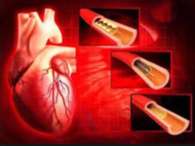 Stent prices: Firms, hospitals, doctors got away with looting