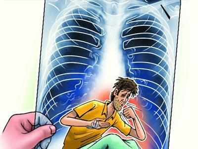 Environmental factors contribute to the rise of TB: Study