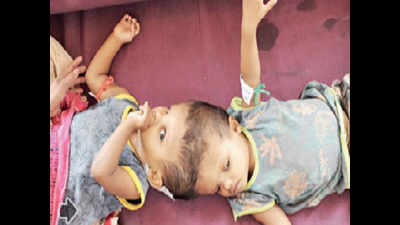 AIIMS Surgery: Odisha twins separated partially, shifted to ICU