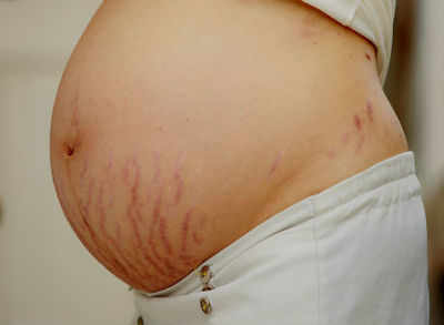 Red deals stretch marks