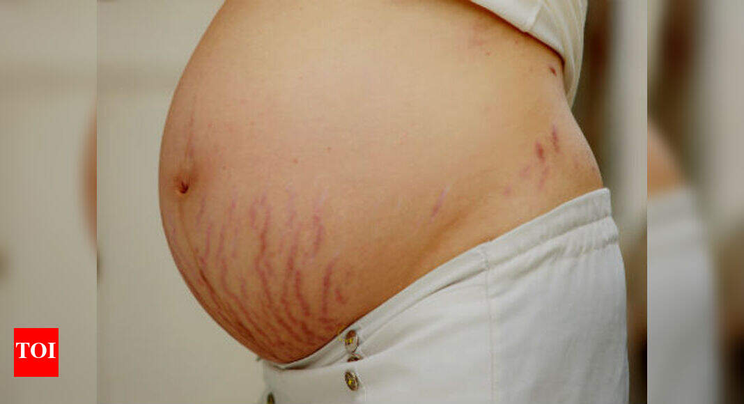 White Stretch Marks The Difference Between Red And White Stretch Marks Times Of India